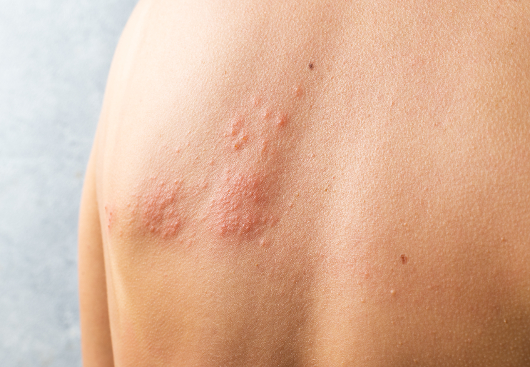Diabète et zona : prévenir les risques par la vaccination